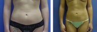 Liposuction to abdomen and flanks