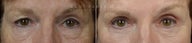Before and After bilateral upper lower blepharoplasty, canthoplasty