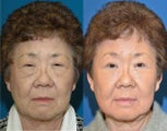 Asian blepharoplasty and ptosis repair.
