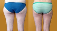 Liposuction