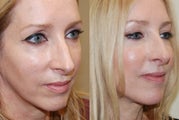 Silikon-1000 treatment to lower eyelid grooves and cheeks. Botox.