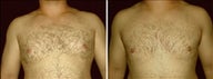 32 year old male, male breast reduction