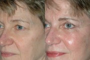 Eyelid Surgery