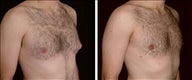 23 year old male, male breast reduction