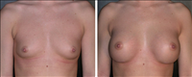 Breast Augmentation