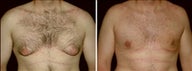 21 year old male, male breast reduction