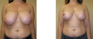 Breast Reduction