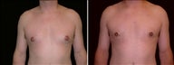 38 year old male, male breast reduction