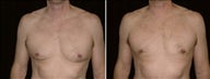 45 Year Old Male, male breast reduction