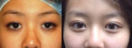 Asian eyelid surgery (asymmetry)