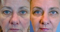 Eyelid Surgery