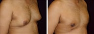 22 year old male, male breast reduction