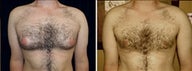 34 year old male, male breast reduction