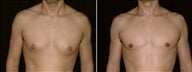 43 year old male, male breast reduction