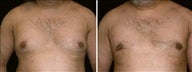 33 year old male, male breast reduction