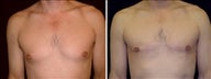 42 year old male, male breast reduction