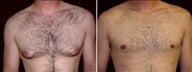 29 year old male, male breast reduction