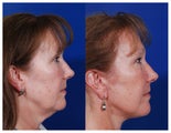 Facelift