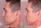 Revision Rhinoplasty
