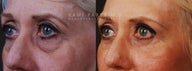 Lower eyelid blepharoplasty autologus fat injection