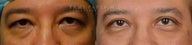 before After bilateral upper eyelid blepharoplasty