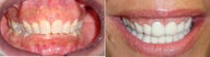 Complete Smile Makeover with porcelain Veneers.