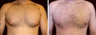 32 year old male, male breast reduction
