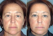 Botox Patient