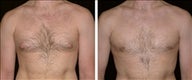 31 year old male, male breast reduction