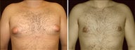 18 year old male, male breast reduction