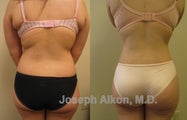 Liposuction