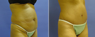 Liposuction