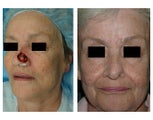 Reconstruction of a Full Thickness Nasal Defect after Mohs Surgery