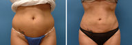 Liposculpture 