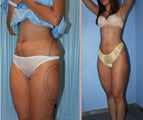 24 year women came to surgery with us for liposuction to be in better shape