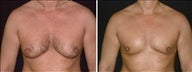 43 year old male, male breast reduction