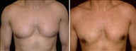 26 year old male, male breast reduction