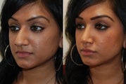 Rhinoplasty Surgery. 6 months post-op