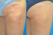 Cellulaze