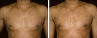 29 year old male, male breast reduction