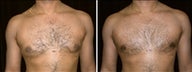31 year old male, male breast reduction