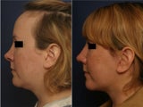 Rhinoplaty Revision and Submental Liposuction