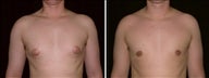 21 year old male, male breast reduction