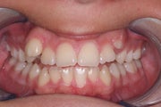 Braces