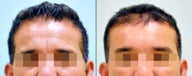 Endoscopic Brow Lift