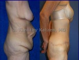 Tummy Tuck