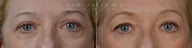 Before and After upper and lower eyelid blepharoplasty