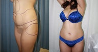 26 years female underwent liposculpturing 