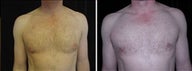 44 year old male, male breast reduction