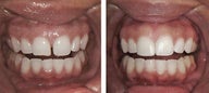 Diastema Bonding Before-and-After